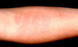 The hand print on my arm